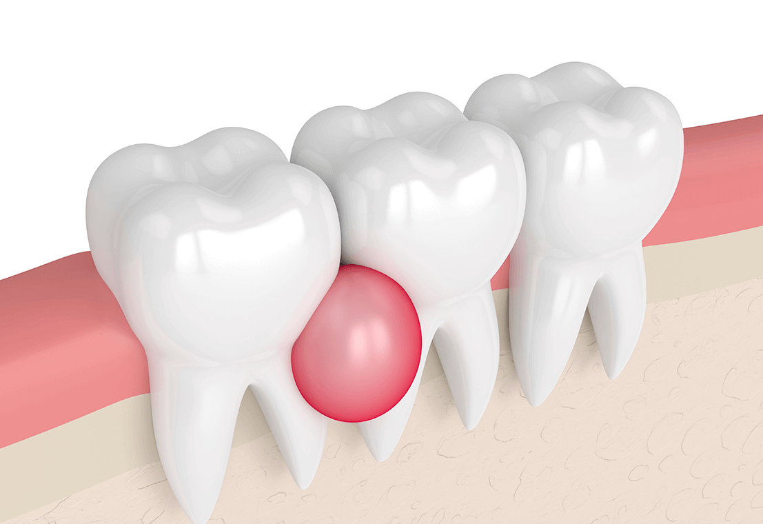 Jaw Cyst Treatment